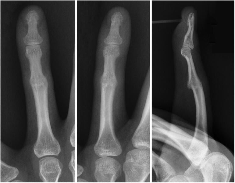 Six-week radiographs showing healing across a fractured symphalangic PIP segment