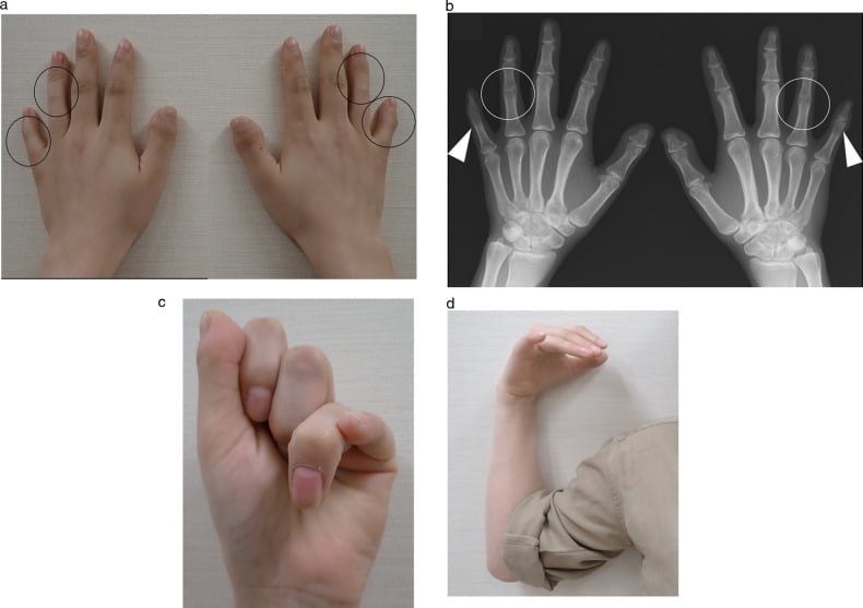 Clinical hand, hand radiograph and restricted elbow motion in NOG-related symphalangism