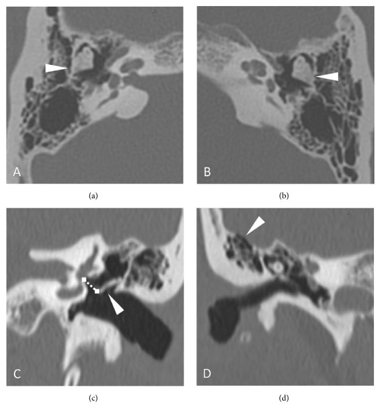 Temporal-bone CT showing bilateral incus and stapes malformations