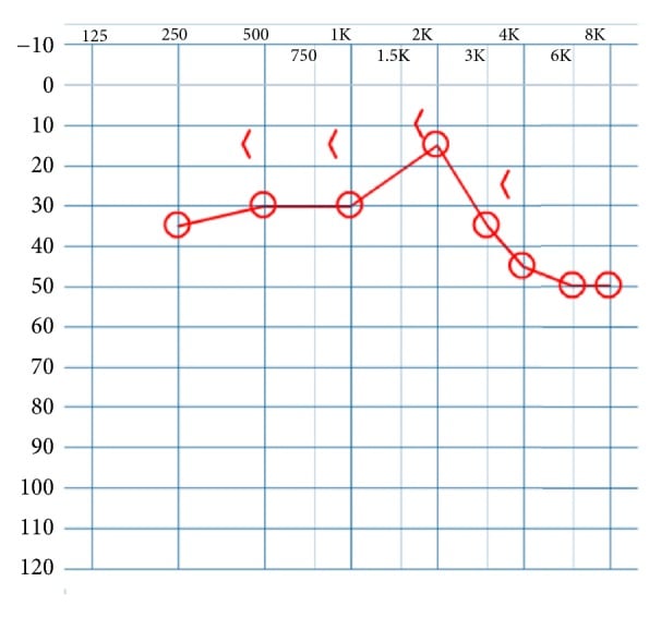 Postoperative audiogram showing early right air-bone gap improvement