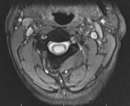 Axial T2 cervical MRI showing a well-defined round CSF-bright cavity in the centre of the spinal cord.