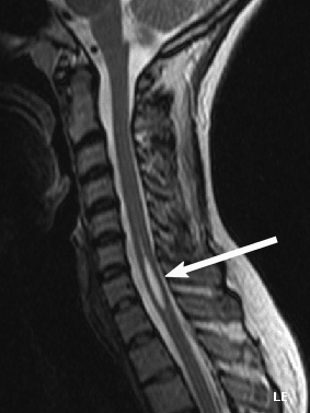 Sagittal cervical MRI showing a longitudinal intramedullary fluid cavity (syrinx, arrow) expanding the spinal cord in syringomyelia.