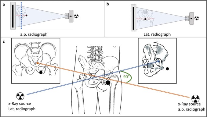 Diagram of orthogonal AP and lateral X-ray beams used for biplanar hip calibration