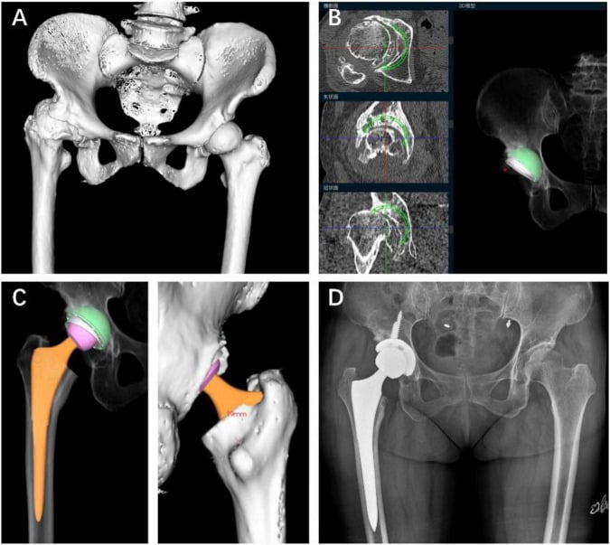 Crowe II dysplastic hip shown as CT reconstruction, planned cup and stem, and postoperative radiograph