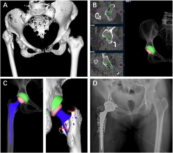 Crowe IV post-septic hip with CT reconstruction, planned components and a stem template extending beyond the femoral bony envelope