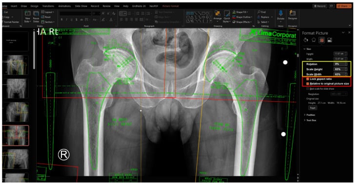 AP pelvis with digital acetabular cup and femoral stem templates overlaid on both hips in presentation software