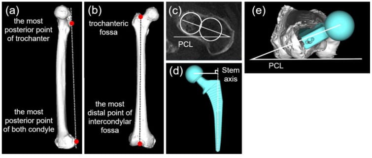 CT-based femoral models defining the posterior condylar line, femoral axis, native neck anteversion and stem version