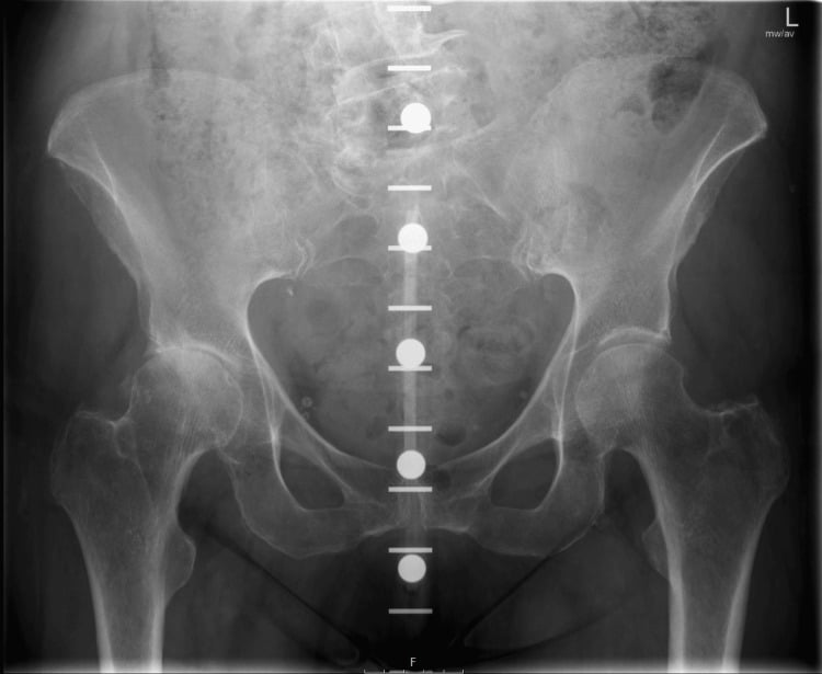 AP pelvis radiograph showing the KingMark graduated radiopaque ruler with spherical markers projected down the midline