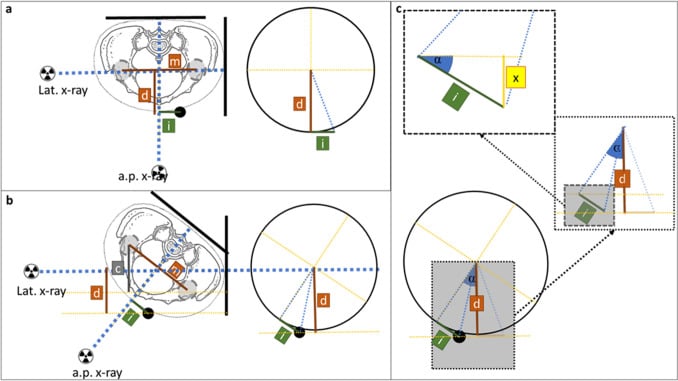 Projection diagrams showing how patient rotation and marker offset alter hip calibration measurements