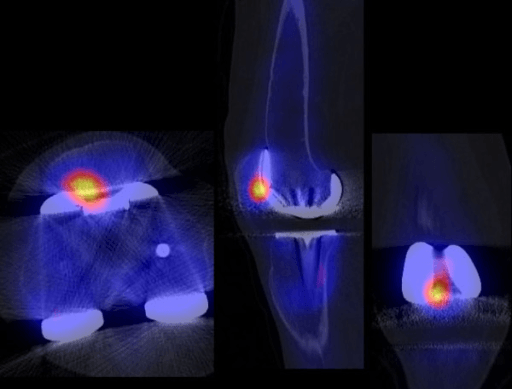 SPECT/CT of a total knee replacement with intense tracer uptake at the patellofemoral articulation.
