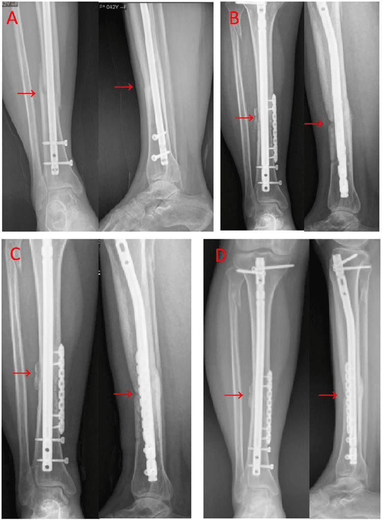 Serial tibial radiographs before and after augmentation plating and autologous bone grafting