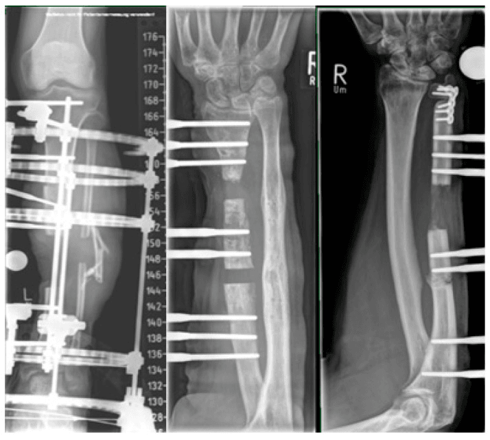 Radiographic examples of classic segmental bone transport including the tibia