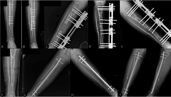 Serial tibial radiographs (A-I) of docking-site refracture revised with intramedullary nailing and graft