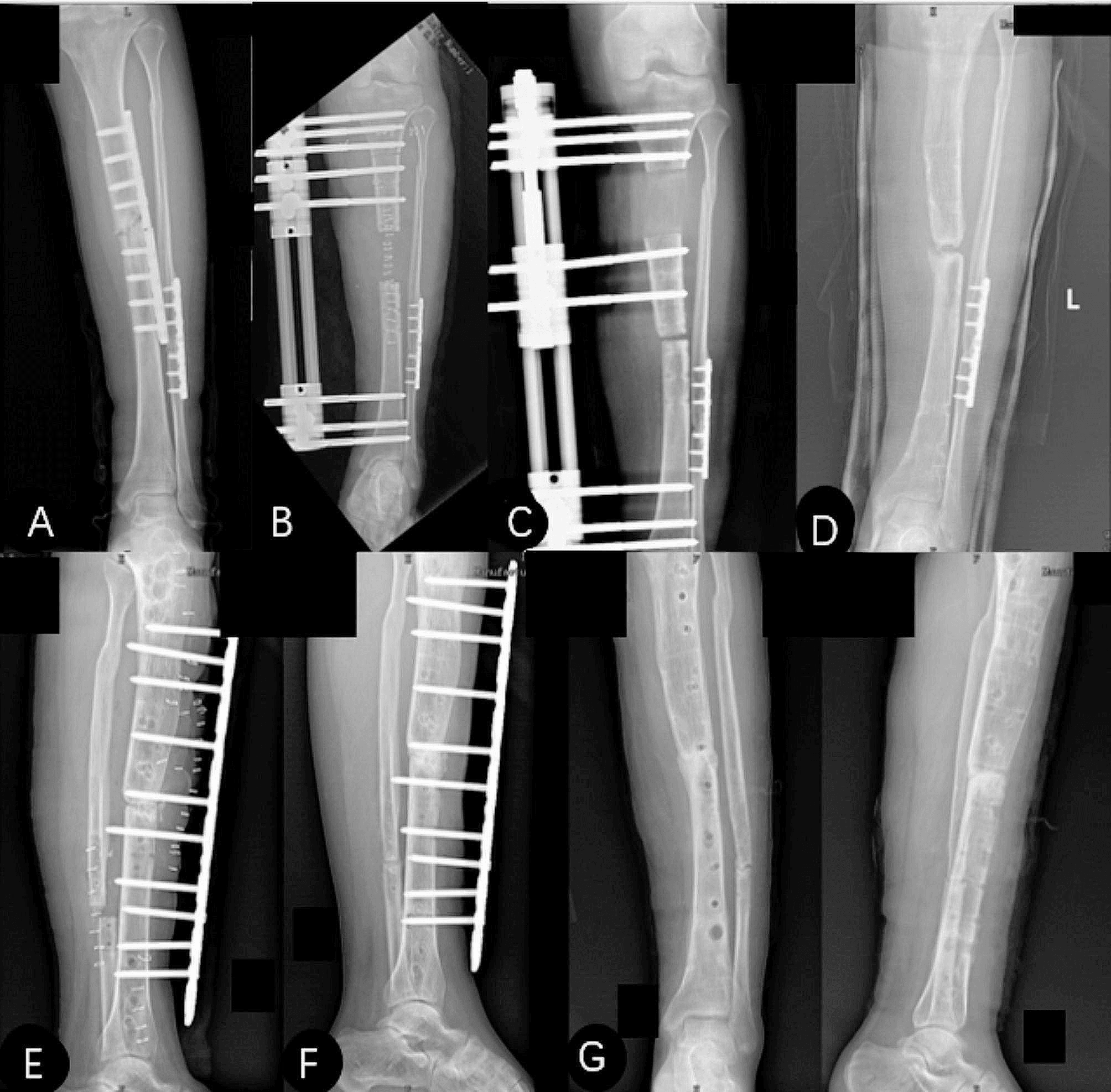 Serial radiographs (A-G) of docking-site refracture and plate revision after tibial bone transport