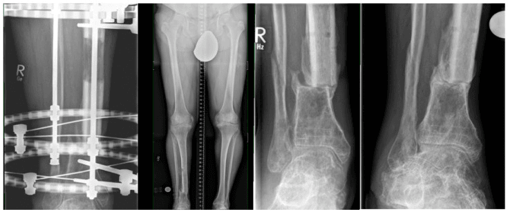 Radiographs of tibial transport in a circular frame, a standing full-length film and the distal docking site showing translation and later remodelling