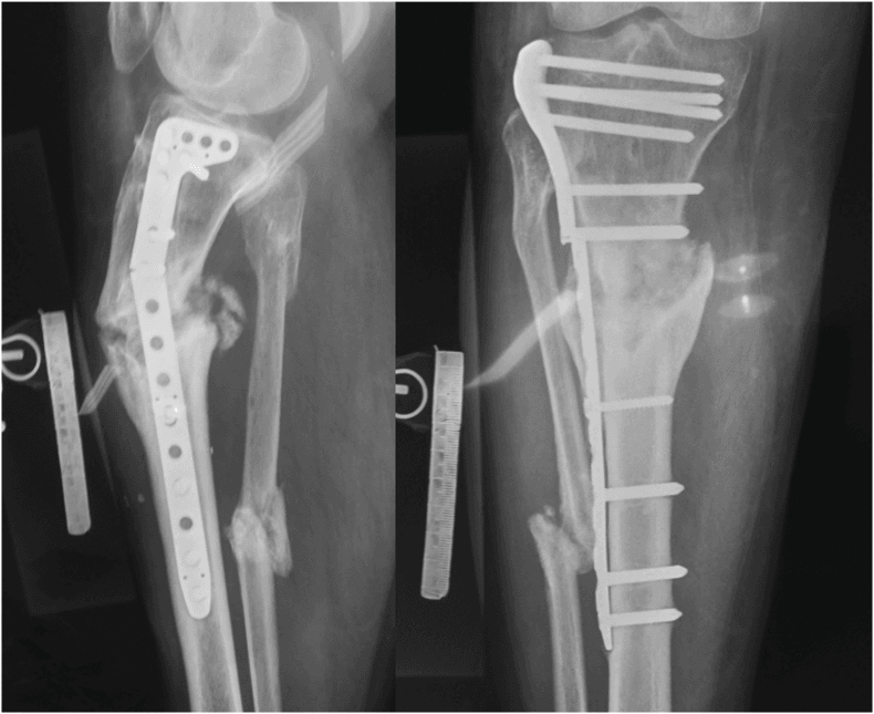 Two radiographic views of a plated hypertrophic tibial nonunion with angulation, a calibration ruler beside the leg