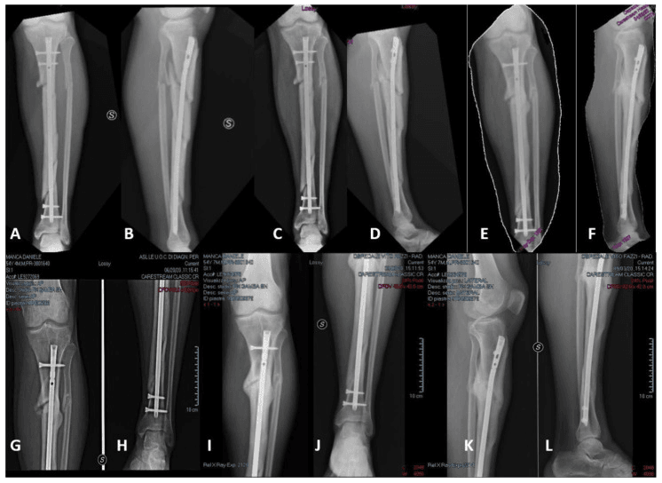 Serial radiographs (A-L) of aseptic tibial nonunion after reamed nailing and biologic augmentation