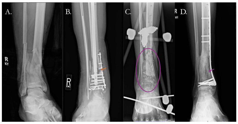 Four-panel radiograph series (A-D) of a septic distal tibial nonunion reconstructed with the induced-membrane technique