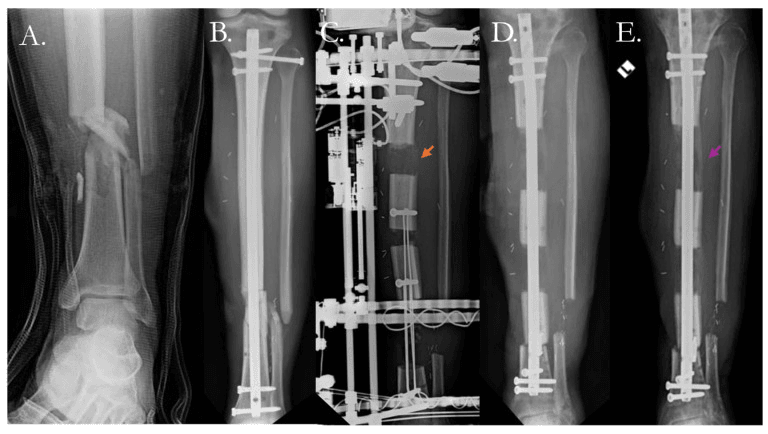 Five-panel radiograph series (A-E) of a segmental septic tibial nonunion treated by resection and distraction osteogenesis