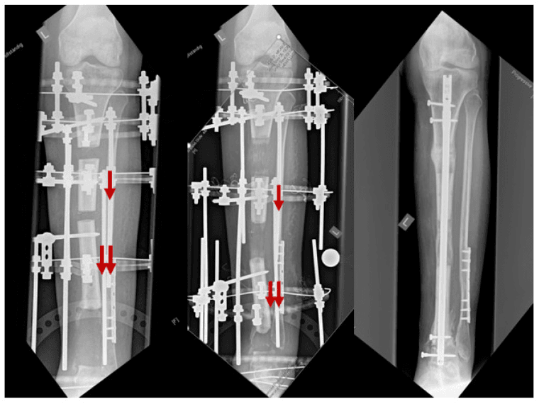 Serial radiographs of tandem multifocal tibial bone transport and nail conversion
