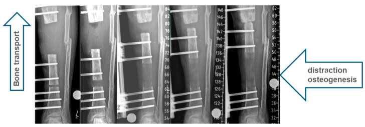 Serial radiographs of tibial bone transport, labelled bone transport and distraction osteogenesis