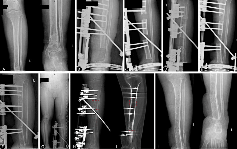 Serial radiographs of trifocal tibial bone transport from defect reconstruction to union