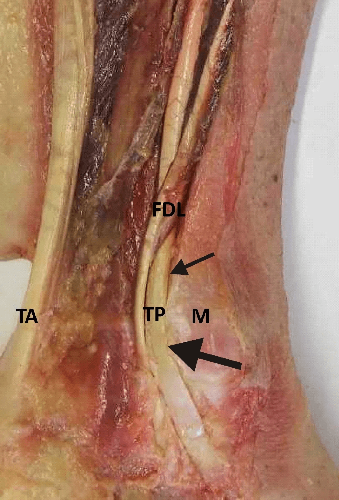 Cadaveric dissection of the retromalleolar region showing the tibialis posterior, flexor digitorum longus and flexor hallucis longus tendons with the neurovascular bundle.