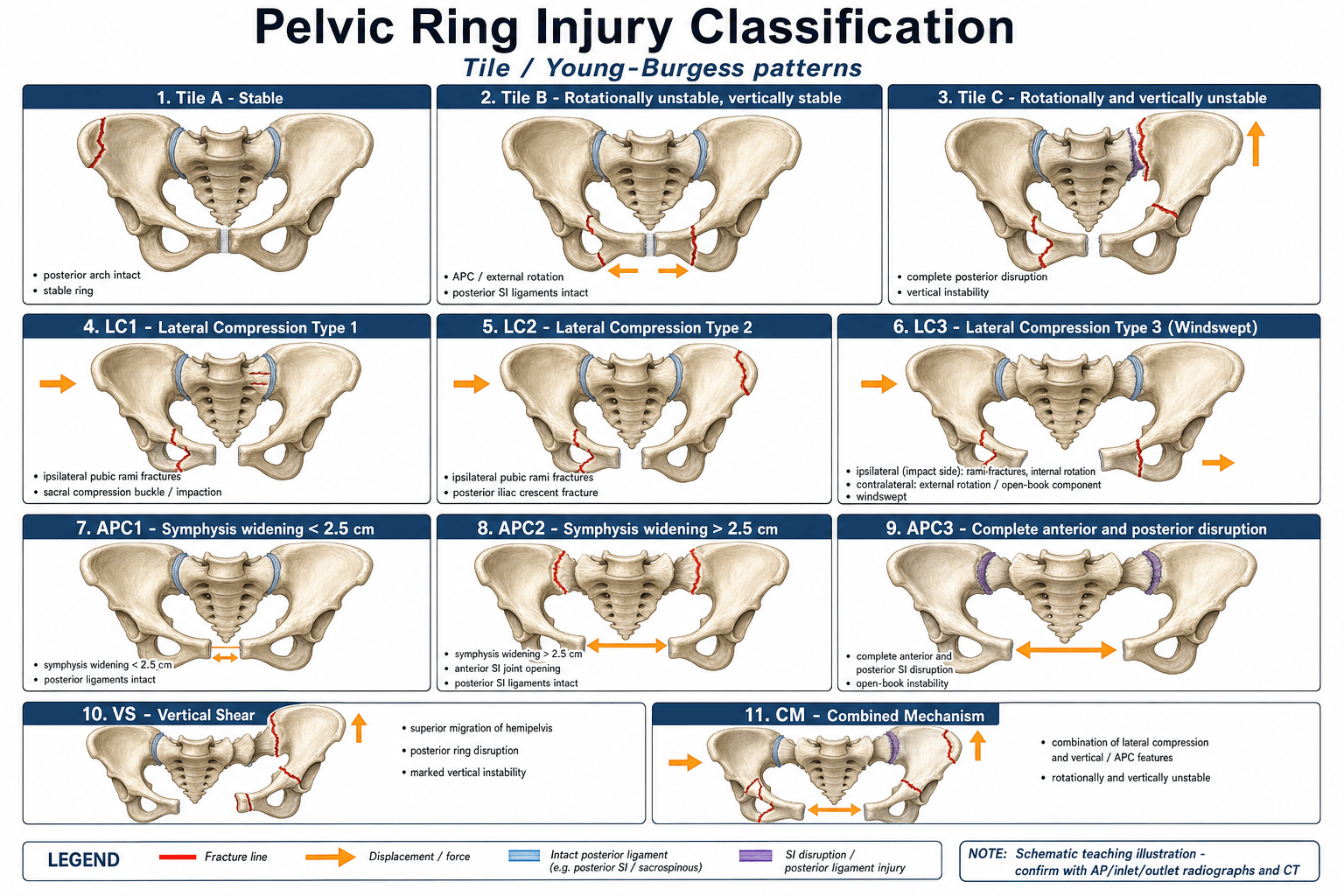 Tile / Young-Burgess Classification of Pelvic Ring Injuries
