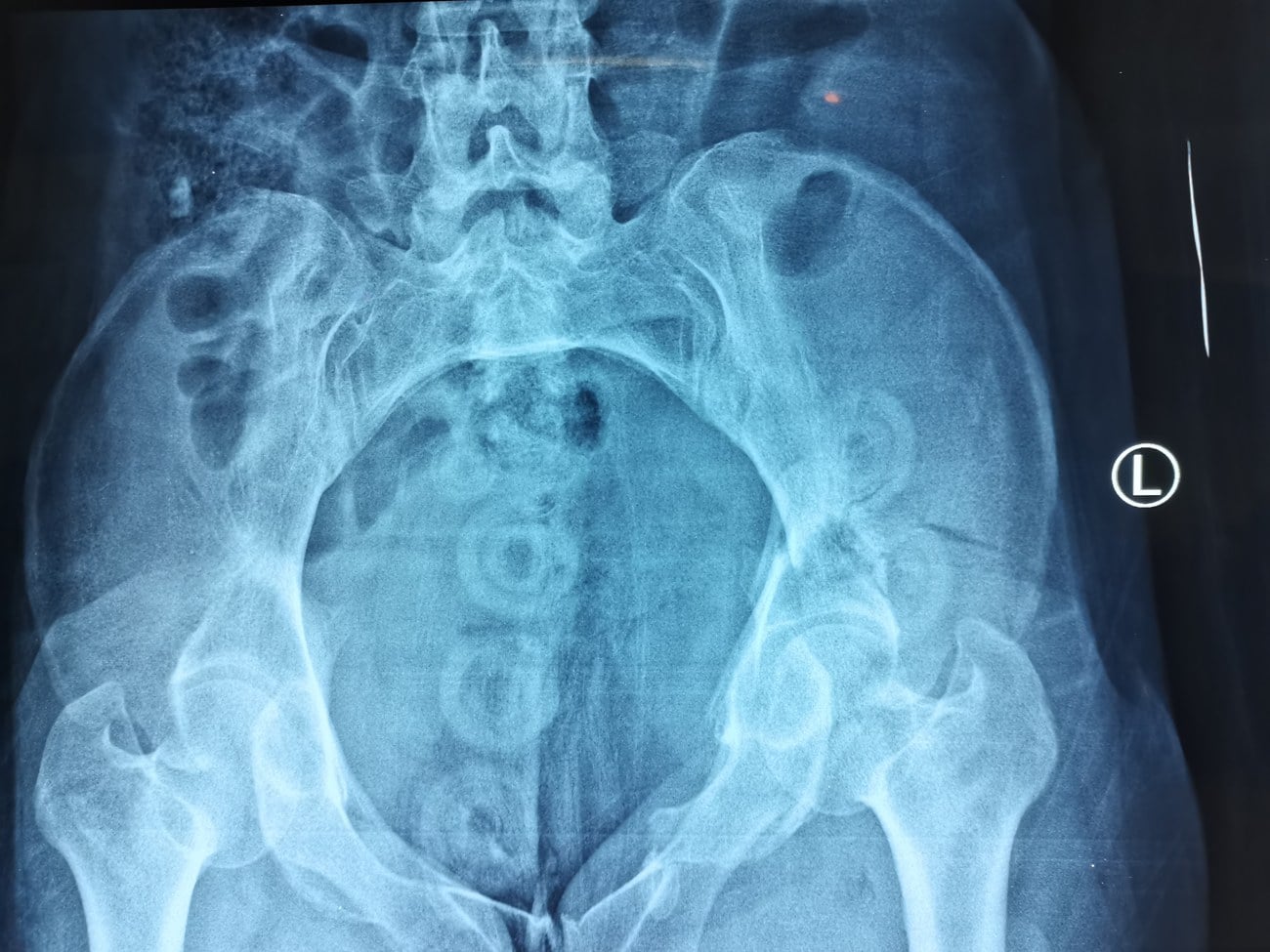 Pelvic inlet view radiograph showing the pelvic brim and ring from an angled caudal projection.