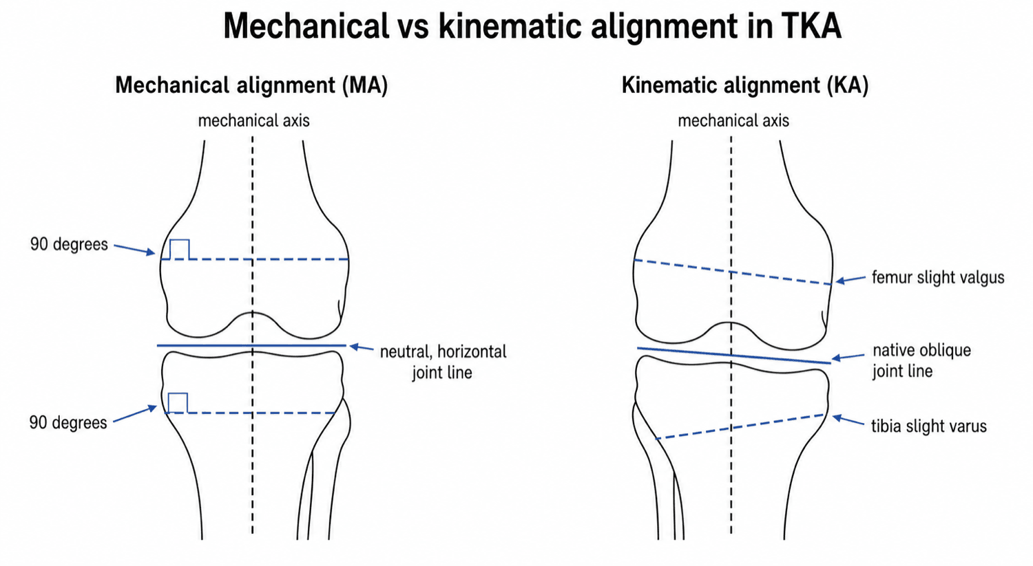 Two-panel schematic contrasting mechanical alignment (perpendicular cuts, horizontal joint line) with kinematic alignment (oblique native joint line).