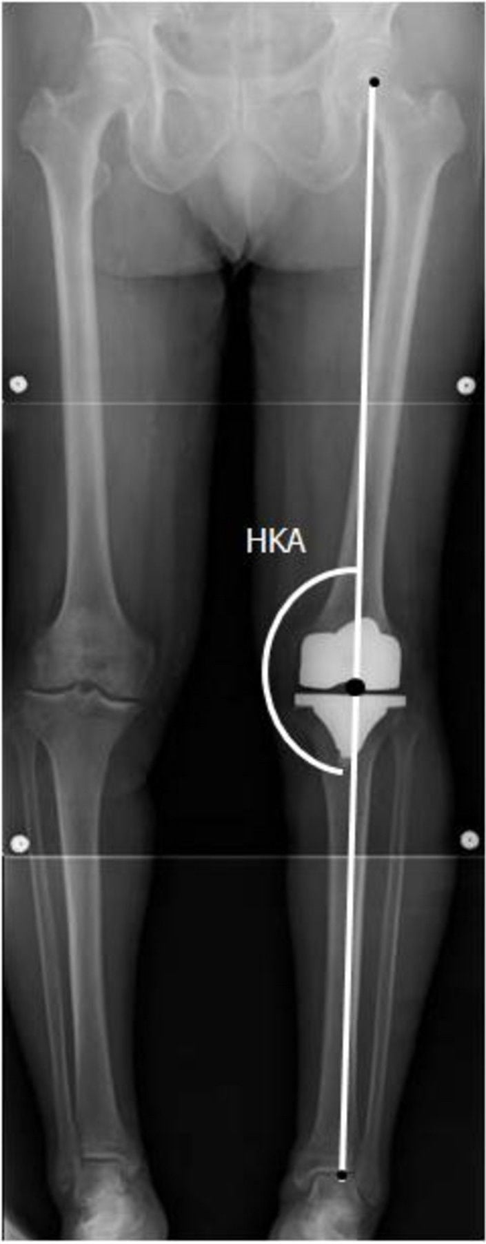 Overview of knee alignment: full-length standing radiograph of both lower limbs with the hip-knee-ankle (HKA) mechanical axis (the mechanism of alignment) drawn through a knee replacement
