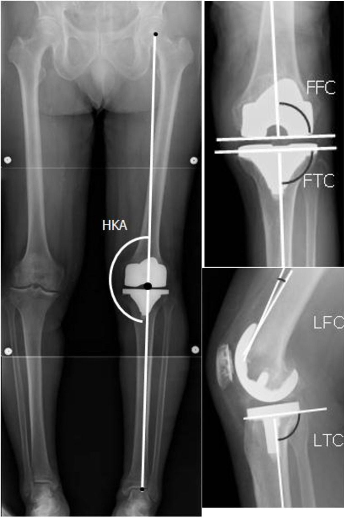 Composite radiograph: full-length HKA mechanical-axis film plus AP (FFC, FTC) and lateral (LFC, LTC) close-ups of a knee replacement's component alignment angles.