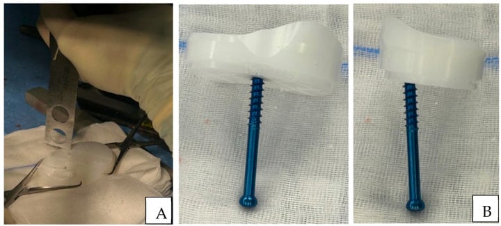 Intraoperative photograph demonstrating tibial trial liner preparation for articulating spacer