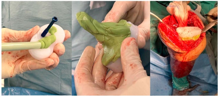 Intraoperative photographs demonstrating cementation and implantation of articulating antibiotic spacer