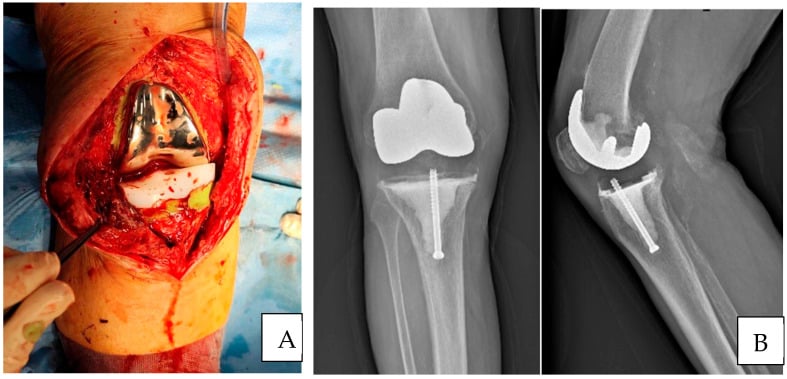 Intraoperative photograph and postoperative AP/lateral radiographs of articulating antibiotic spacer