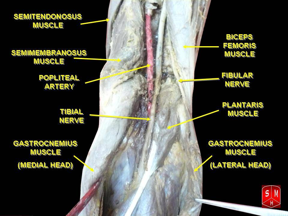 Cadaveric dissection of the popliteal fossa showing the popliteal artery, tibial nerve and common peroneal (fibular) nerve.