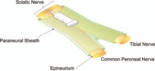 Schematic of the sciatic nerve in the popliteal fossa: the common paraneural sheath surrounds the sciatic nerve before it divides into the tibial and common peroneal nerves.