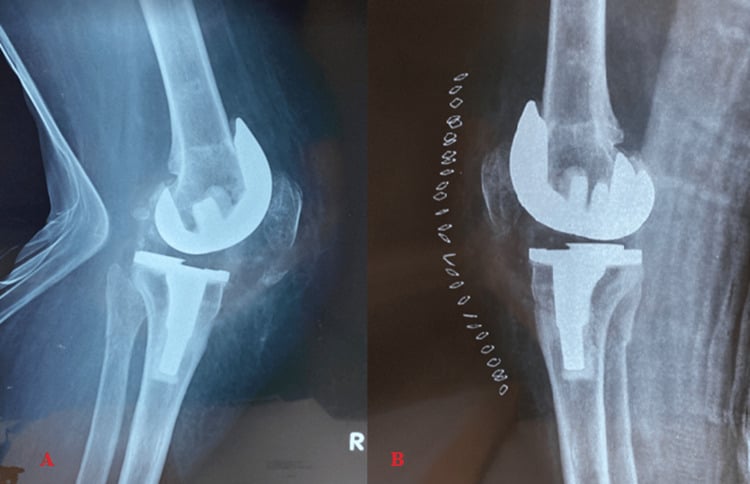 Patellar fracture after TKA with bone suture fixation