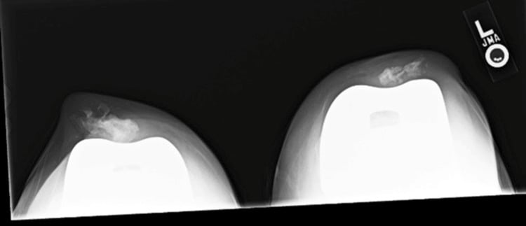 Bilateral sunrise view showing patellar AVN after TKA