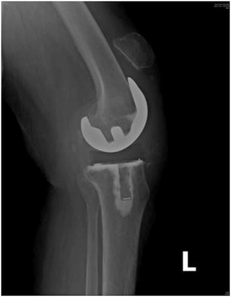 Patellar tendon rupture with patella alta after TKA