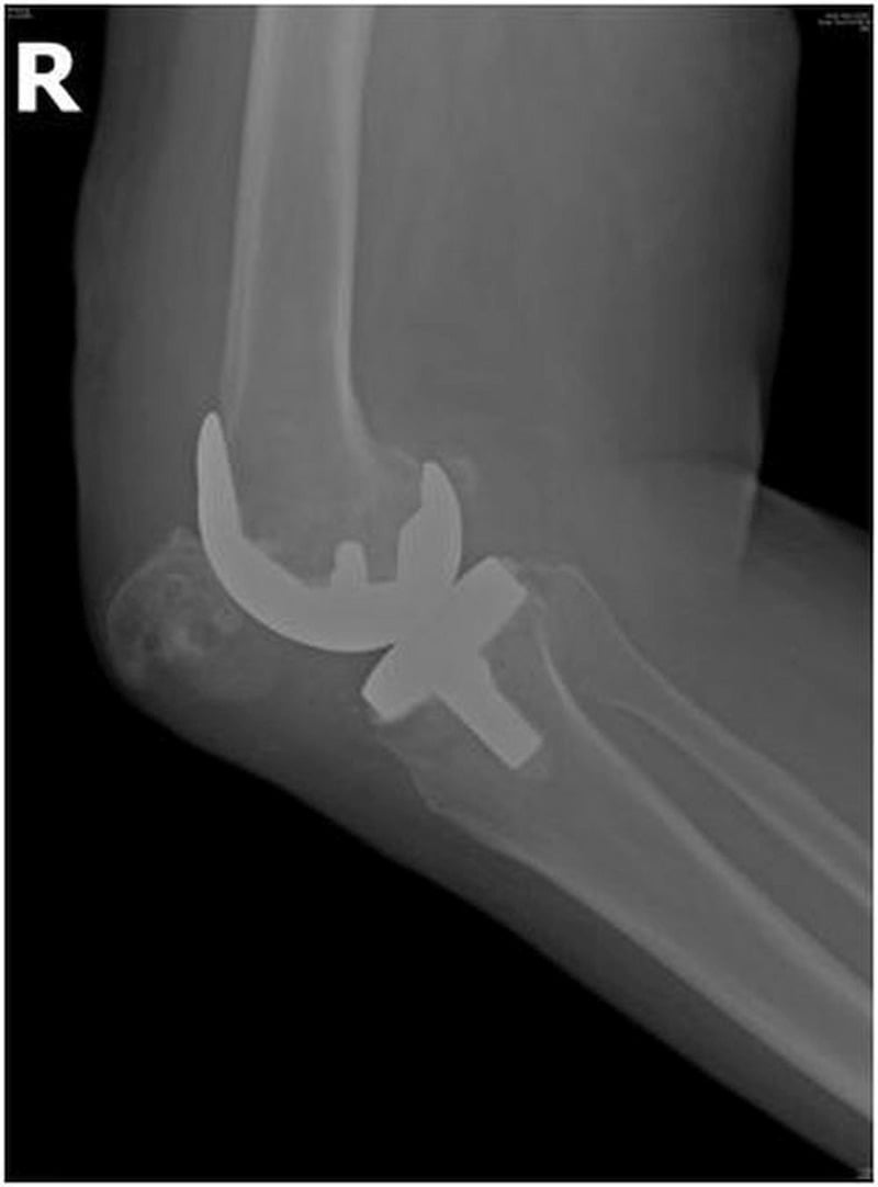 Lateral radiograph showing patellar dislocation after TKA