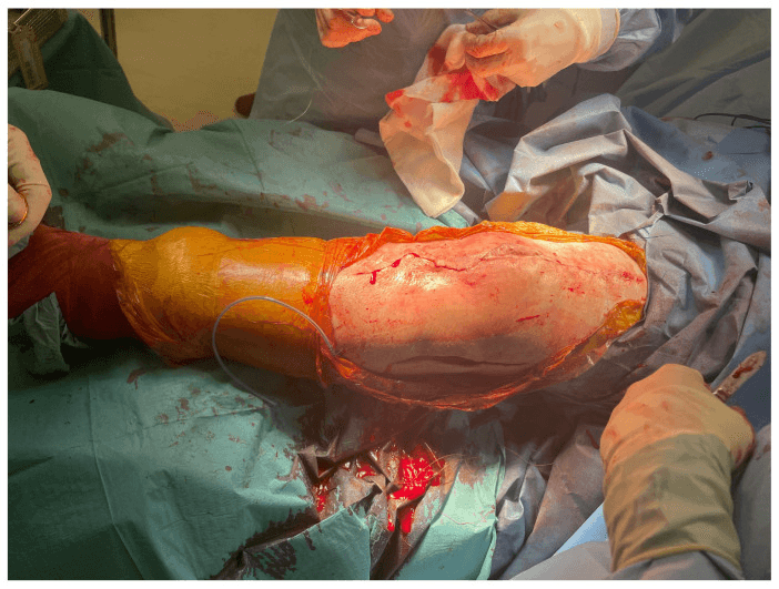 Knee closed with an axial bipedicled local flap after sinus excision, seen under an orange adhesive drape