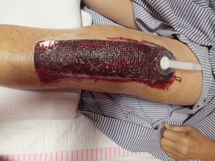 Negative-pressure wound dressing along the leg filled with blood beneath the seal