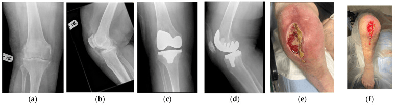 AP and lateral radiographs of a knee without and with a knee replacement, and clinical photographs of a large open anterior knee wound