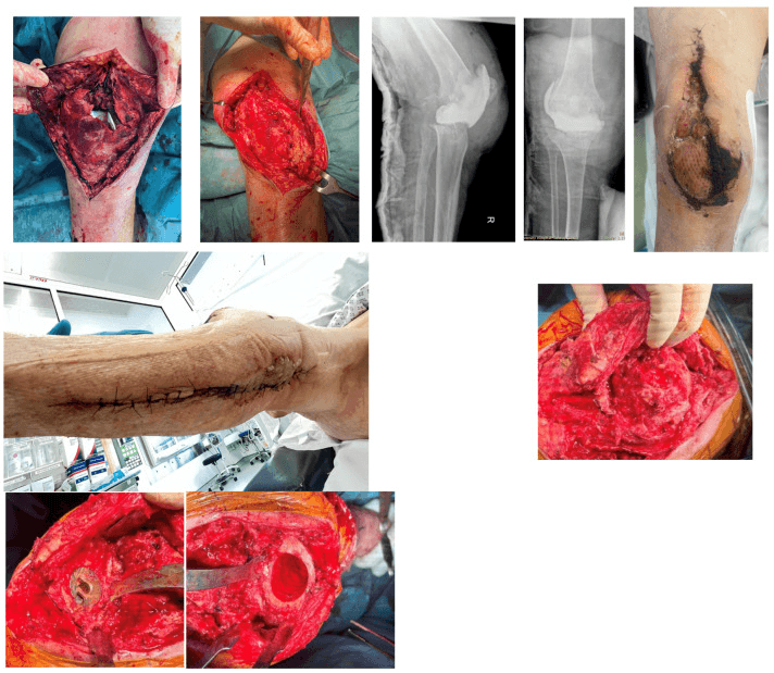 Composite of intraoperative views, knee radiographs and clinical photographs from the treatment course of a complex infected TKA wound
