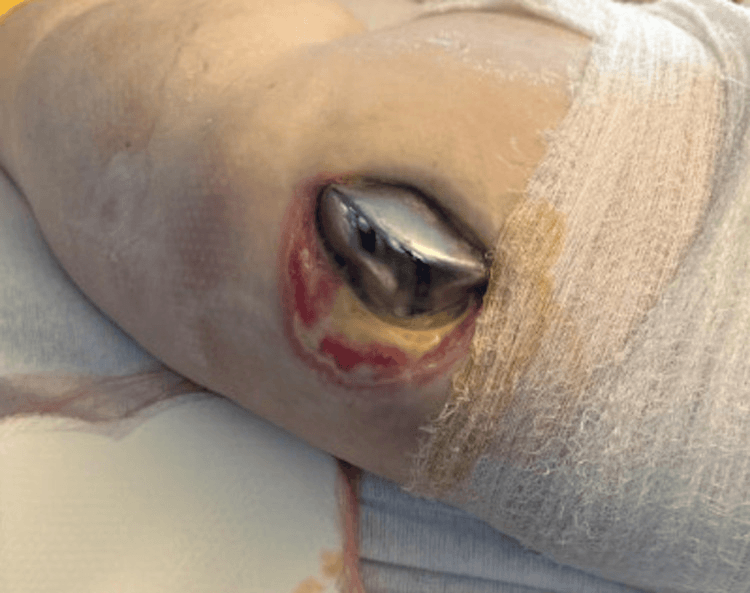 Open knee wound with a metal prosthetic component visible in its base, beside a gauze dressing