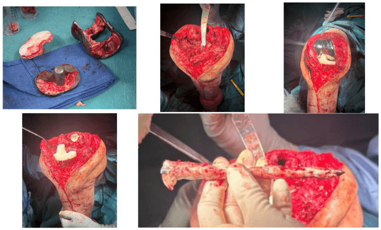 Explanted femoral and tibial components and insert on a towel, and intraoperative views of the open knee during first-stage revision