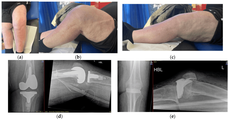 Clinical views of the healed limb in extension and flexion, and two sets of AP and horizontal-beam lateral knee radiographs at final follow-up