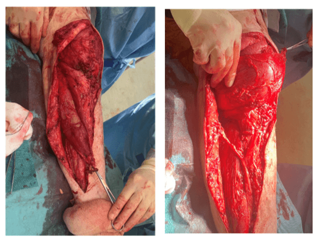 Two intraoperative views of a gastrocnemius muscle flap raised through a long incision down the calf