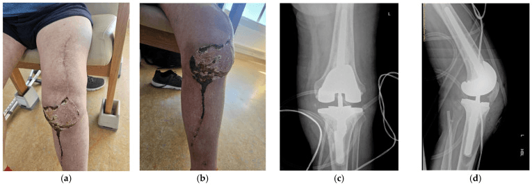 Clinical views of a knee with a long scar and a crusted area below the patella, and AP and lateral radiographs of stemmed revision knee components